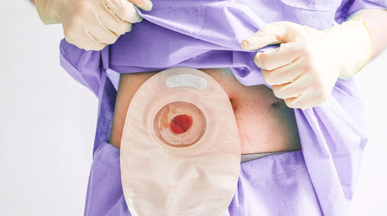 Realizan cirugía de colostomía en Materno Infantil de Macuto